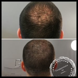 tricopigmentation Bordeaux