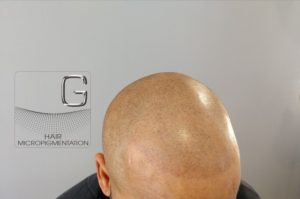 Tricopigmentation originale