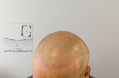 Tricopigmentation Bordeaux