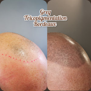 Greg Urfalino artist smp bordeaux #tricopigmentation #tricopigmentationbordeaux #smpbordeaux