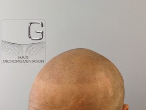 Tricopigmentation Bordeaux
