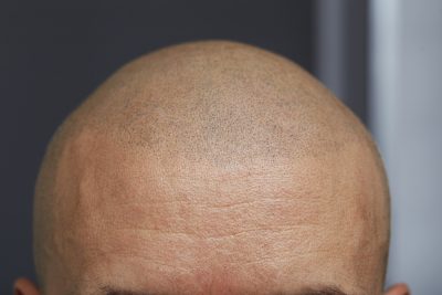 Tricopigmentation Greg Hairmicro Bordeaux